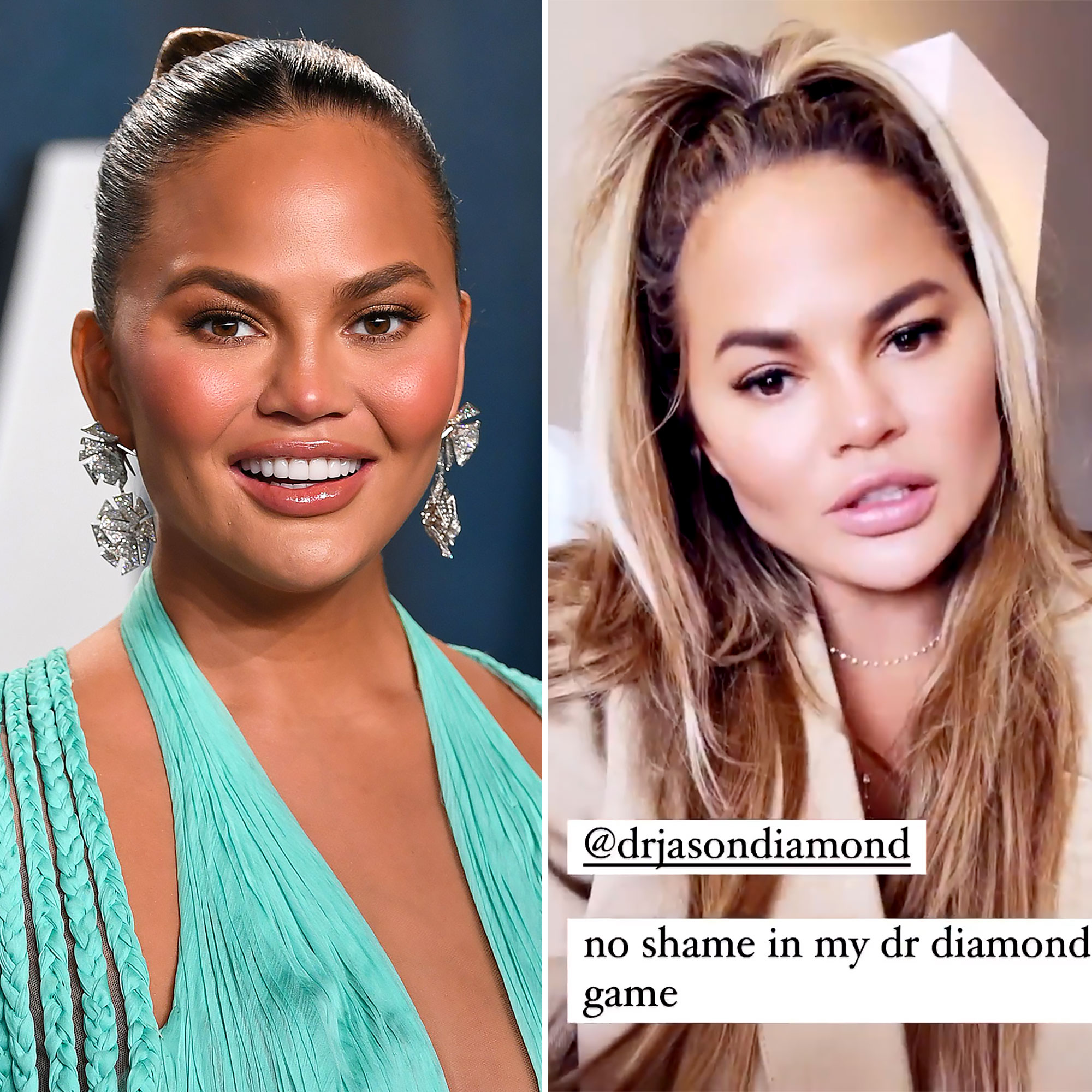 Cheekbone Implants Celebrities: Love Them or Hate Them? Check Out These Shocking Results