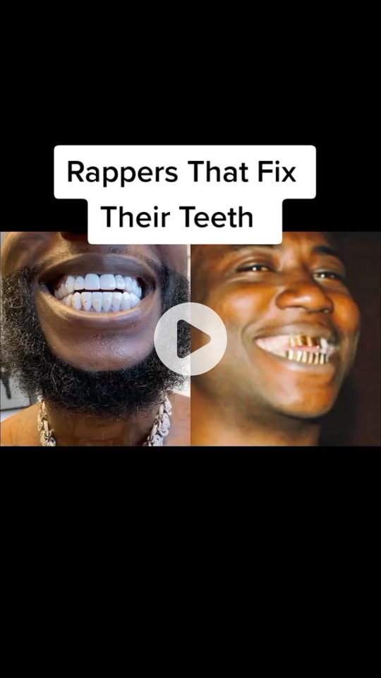 Before and After: Check Out the Amazing Transformation of Gucci Mane Veneers