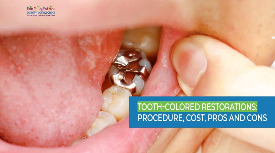 Painted Teeth: Everything You Need to Know (Benefits, Cost, and Aftercare)