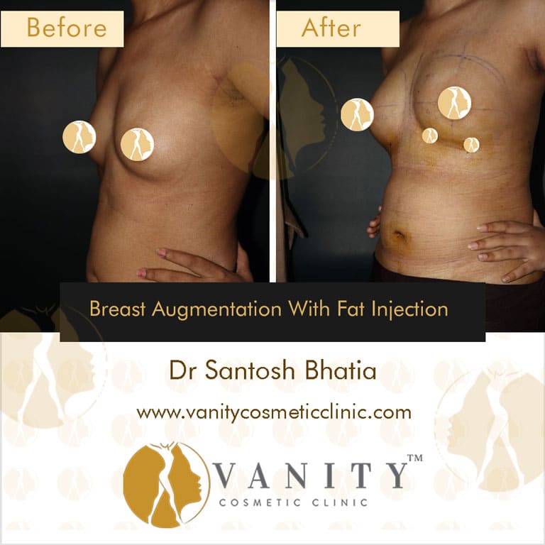 How To Enhance Fatty Big Boobs(Discover The Best Methods Right Now)
