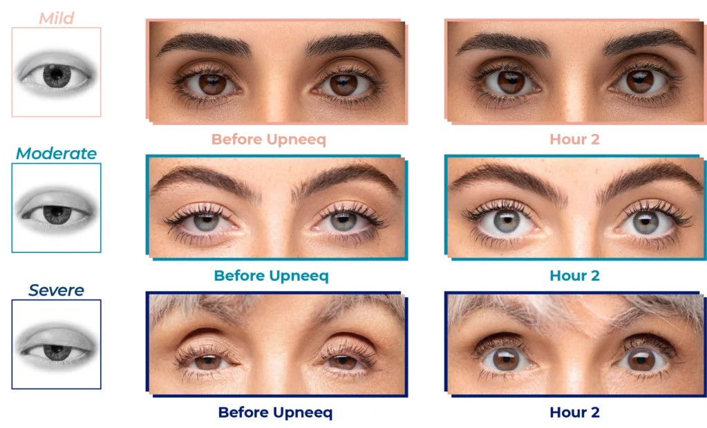 How to make eyelids bigger naturally (easy home remedies that actually work for you)