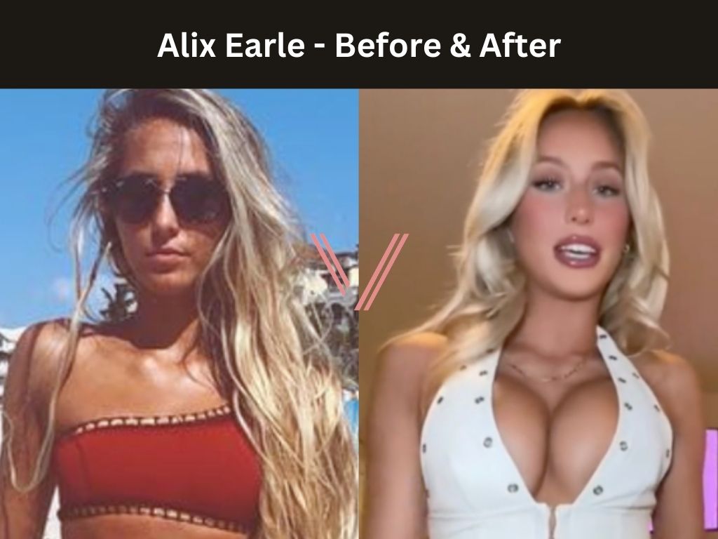 Alix Earle Breast Implants: The Truth About If She Got Work Done or Not